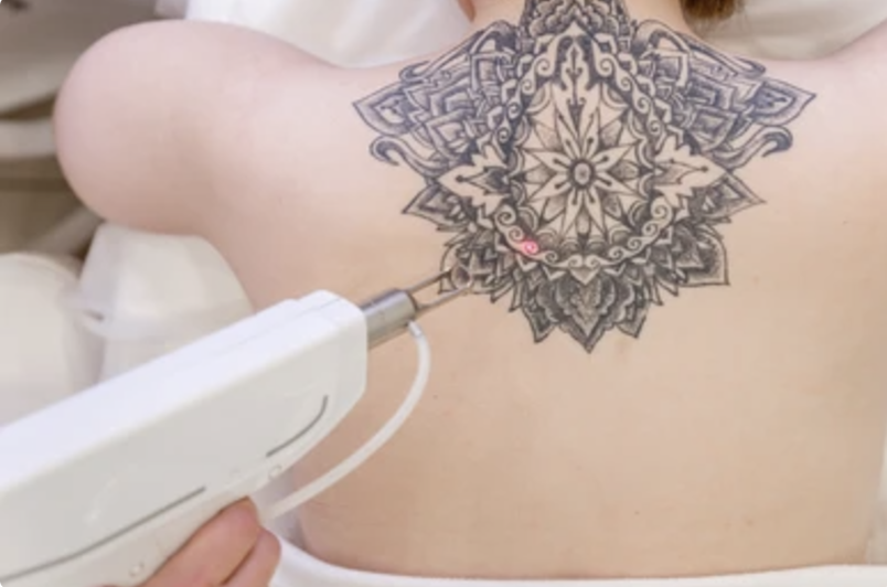 Remoção de tatuagem à Laser