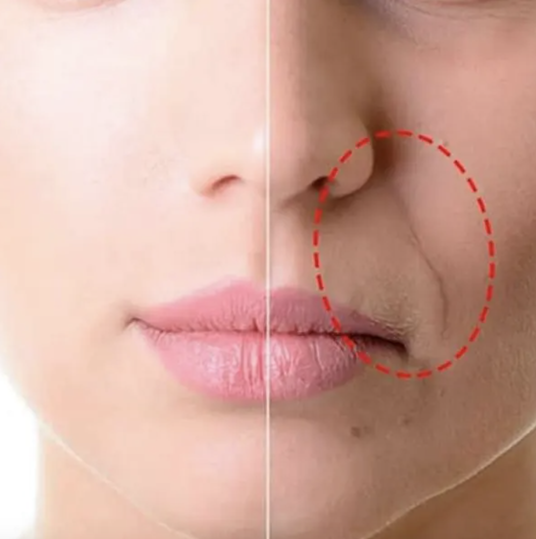 Remoção do Bigode Chinês com Laserterapia
